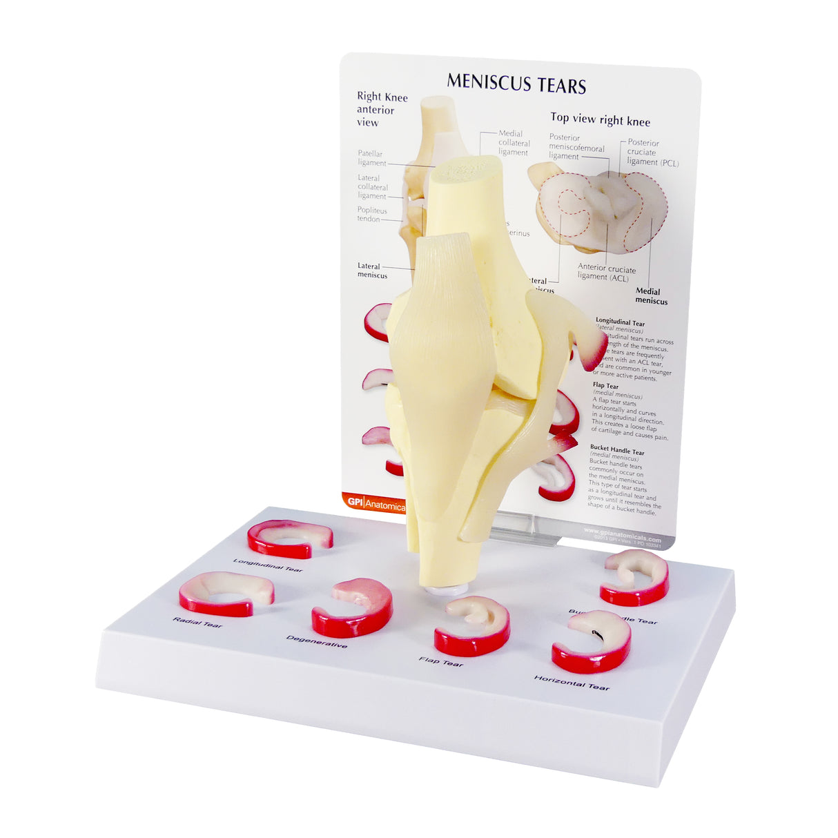 Knee Model with Meniscus Tears