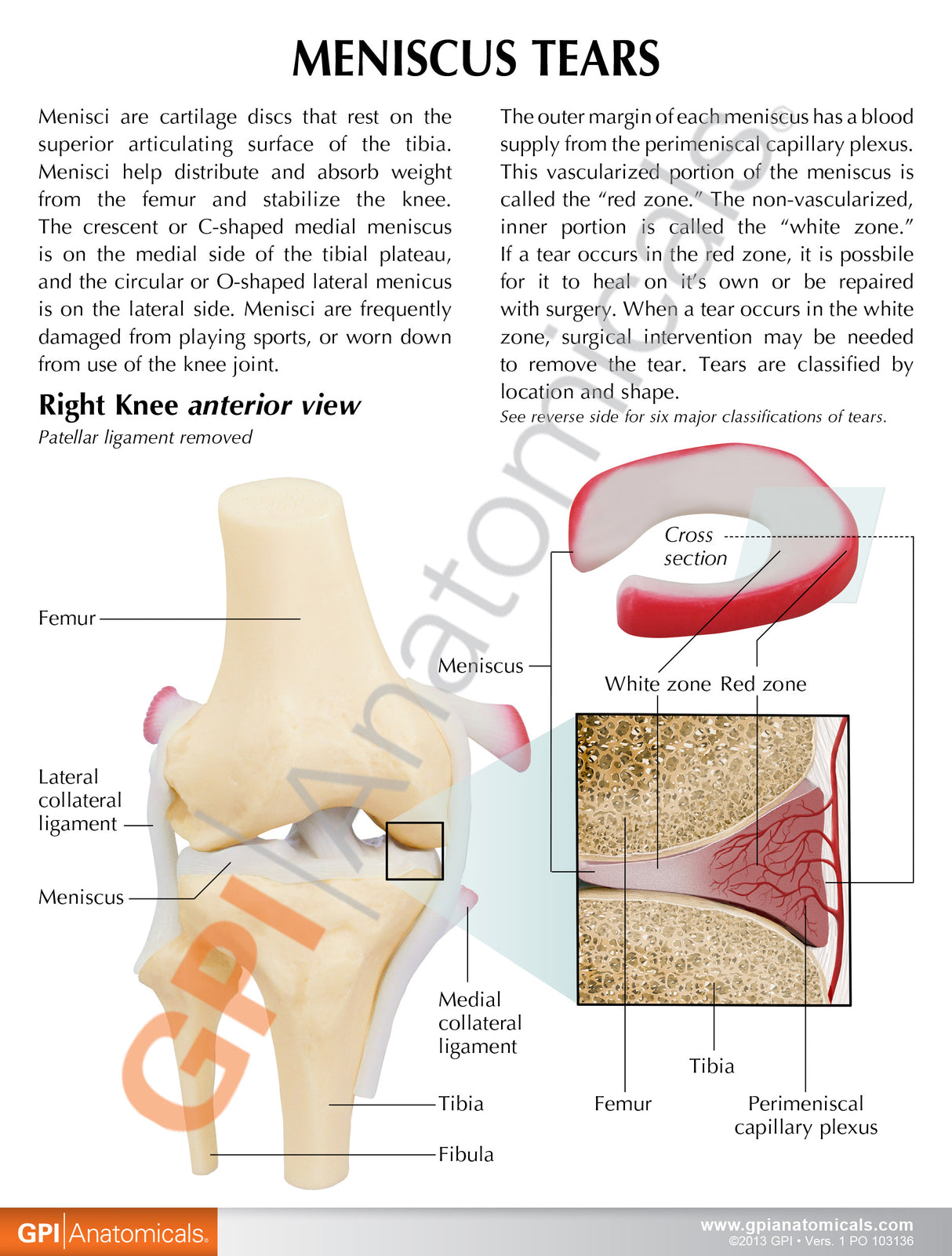 Knee Model with Meniscus Tears Education Card