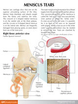 Knee Model with Meniscus Tears Education Card