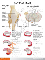 Knee Model with Meniscus Tears Education Card