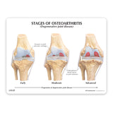 4-Stage Osteoarthritic Knee