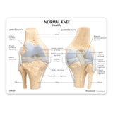 4-Stage Osteoarthritic Knee