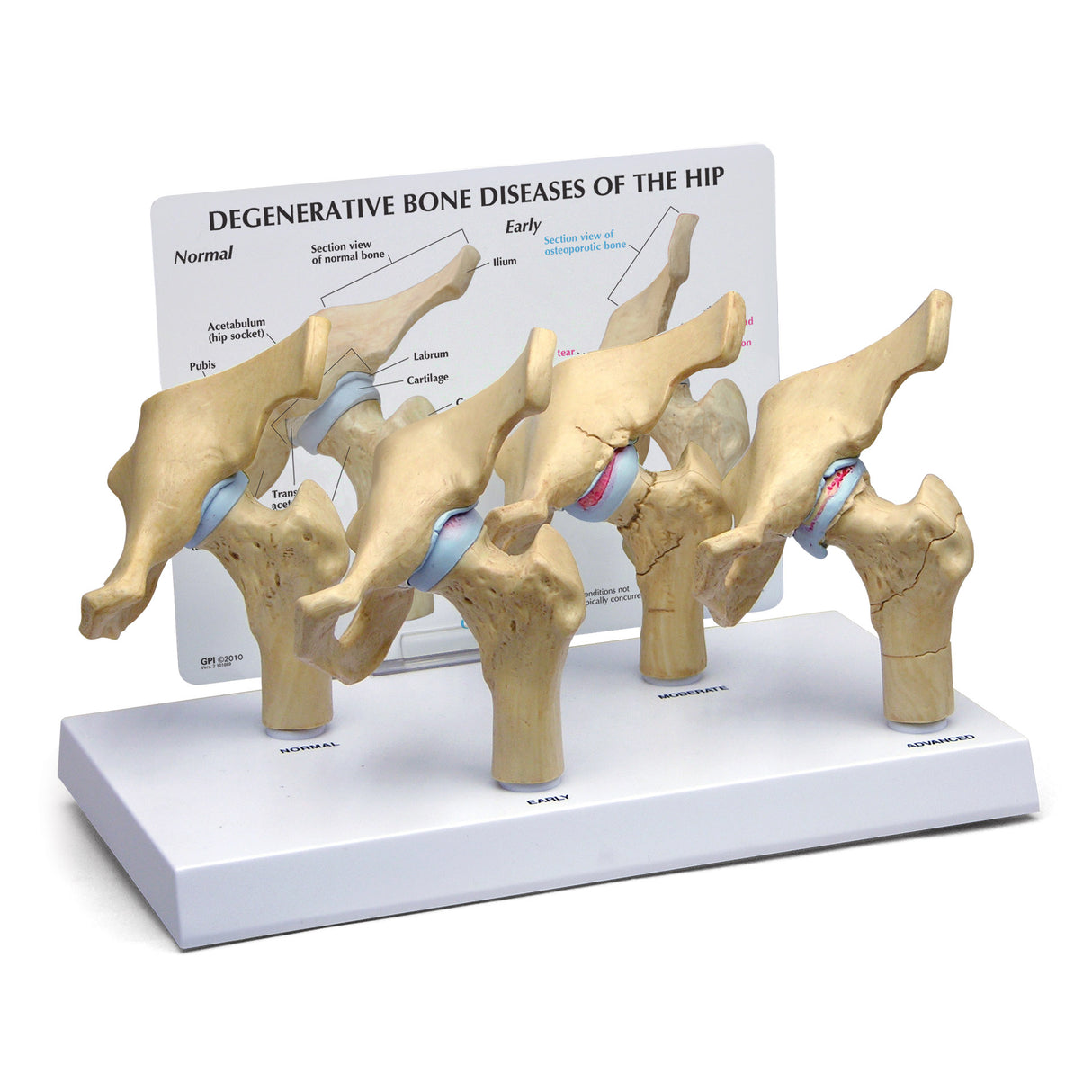 4-Stage Diseased Hip Joint Model Set