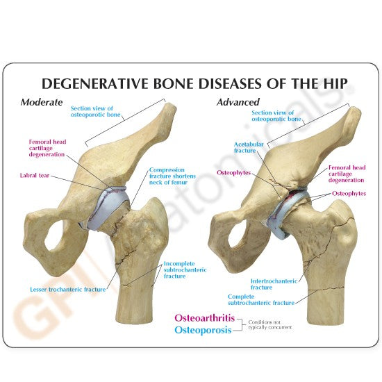 4-Stage Diseased Hip Joint Education Card