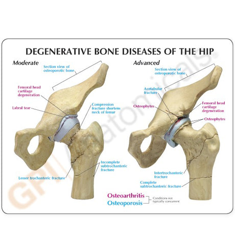 4-Stage Diseased Hip Joint Model Set