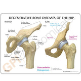 4-Stage Diseased Hip Joint Education Card