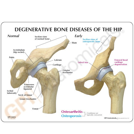 4-Stage Diseased Hip Joint Model Set