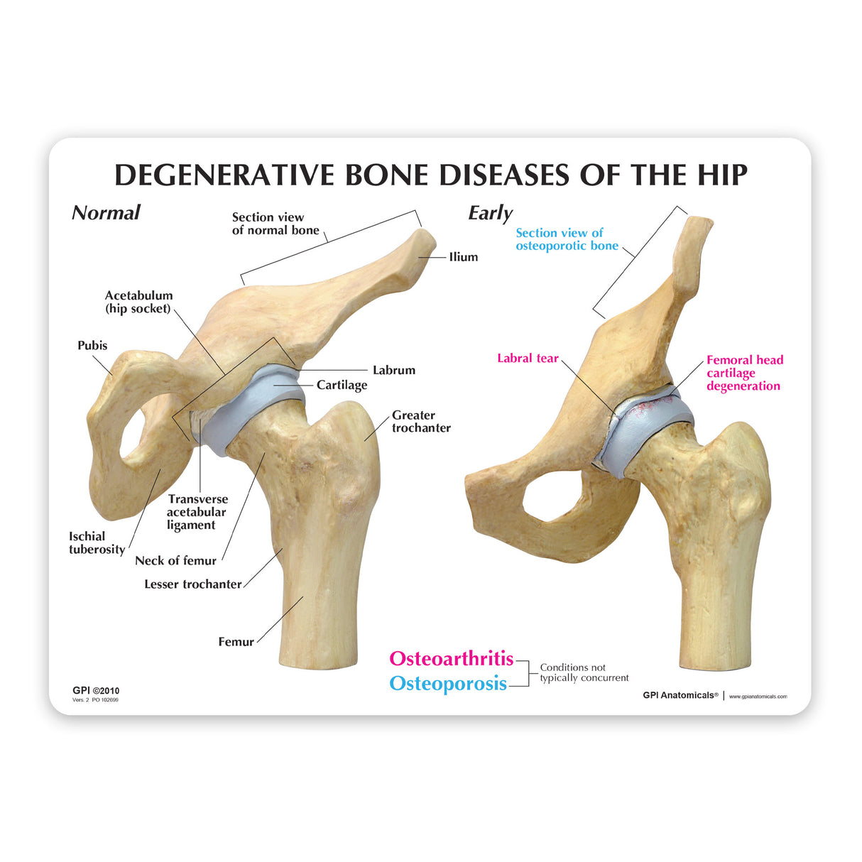 4-Stage Diseased Hip Joint Model Set