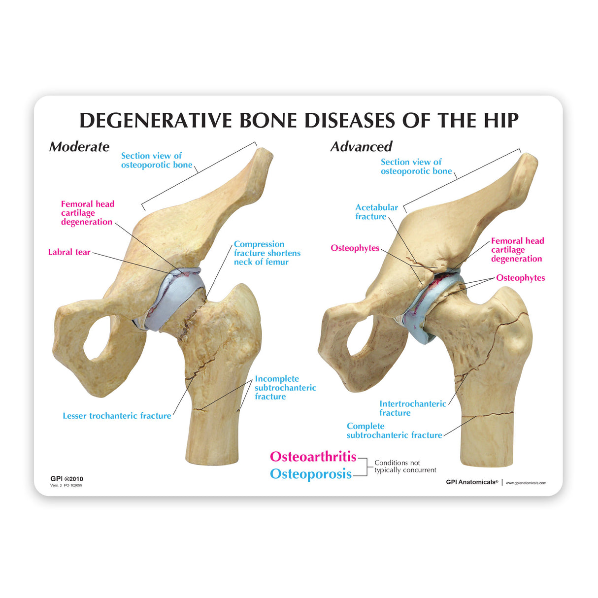 4-Stage Diseased Hip Joint Model Set