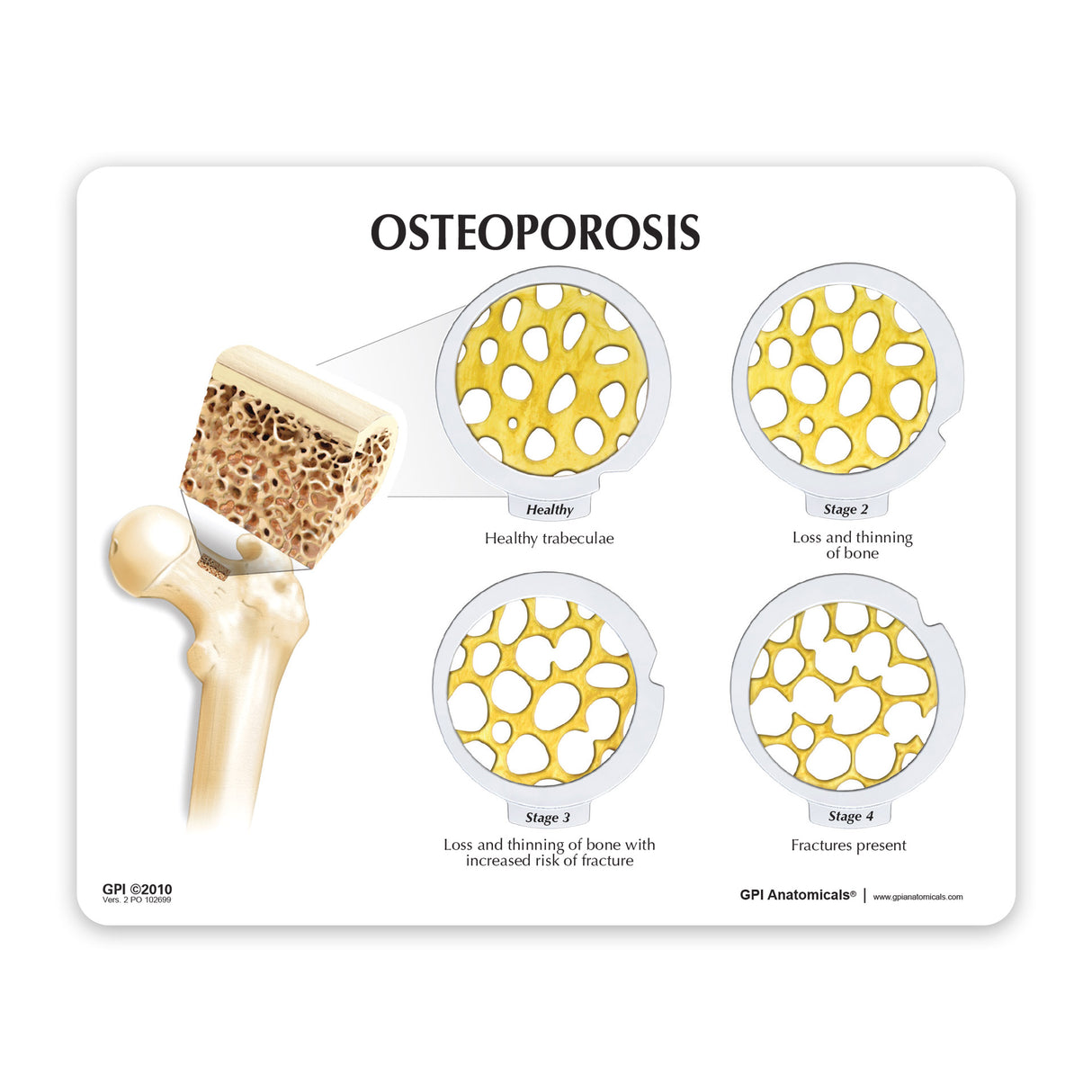 Osteoporosis Education Card