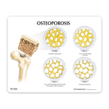 Osteoporosis Model