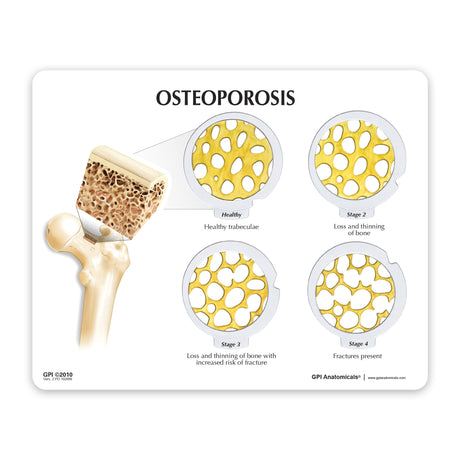 Osteoporosis Model