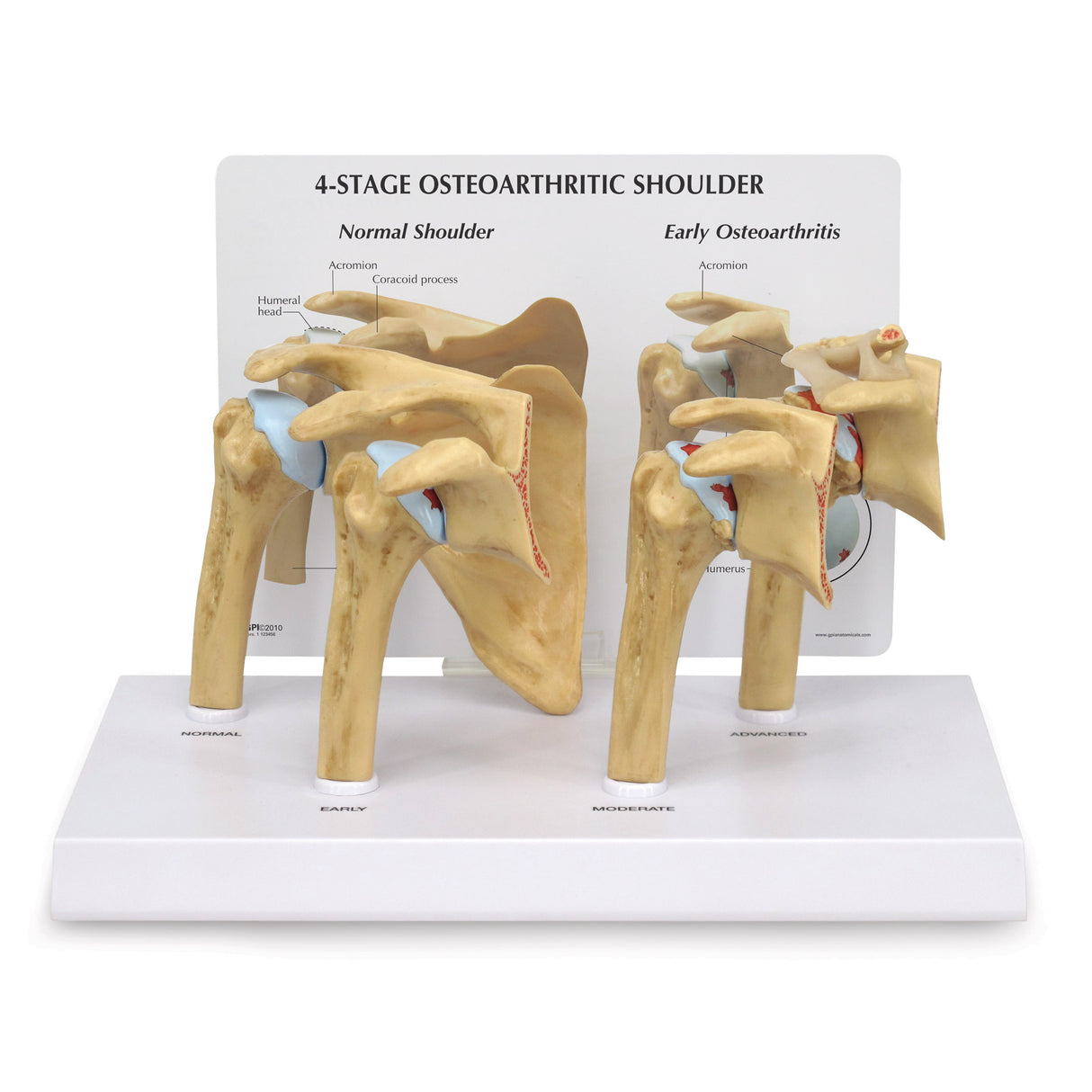 4-Stage Osteoarthritis (OA) Shoulder Model