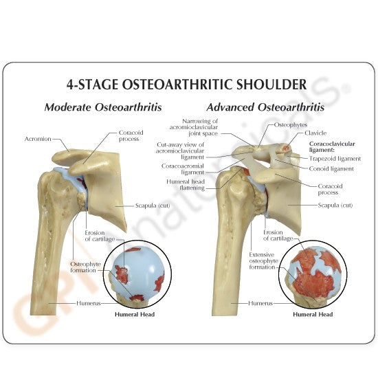 4-Stage Osteoarthritis Shoulder Education Card