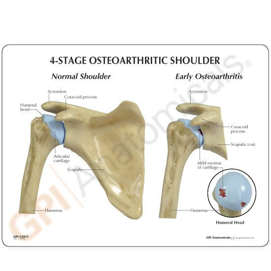 4-Stage Osteoarthritis Shoulder Education Card