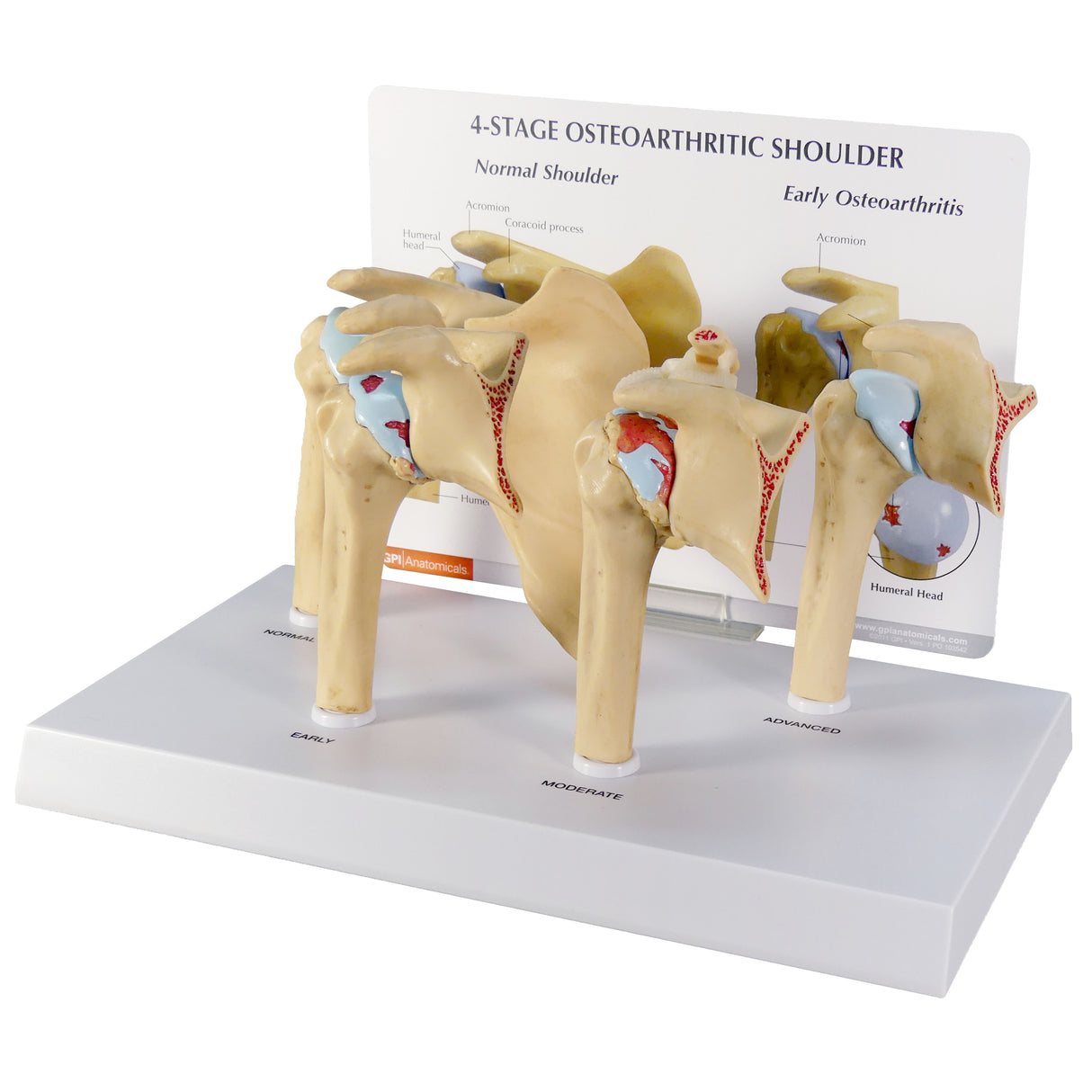 4-Stage Osteoarthritis (OA) Shoulder Model