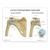 4-Stage Osteoarthritis (OA) Shoulder Model