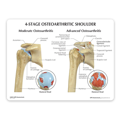 4-Stage Osteoarthritis (OA) Shoulder Model