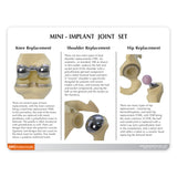 Mini Implant Joint Set