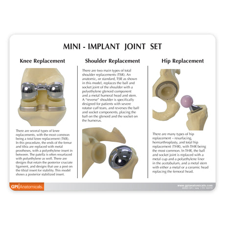 Mini Implant Joint Set