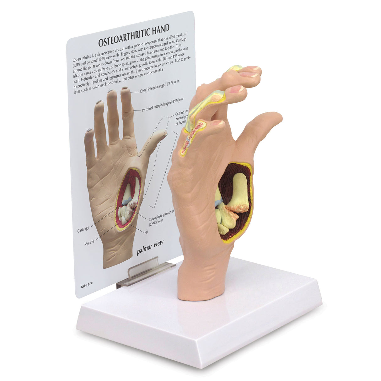 Right Hand Model with Osteoarthritis (OA)