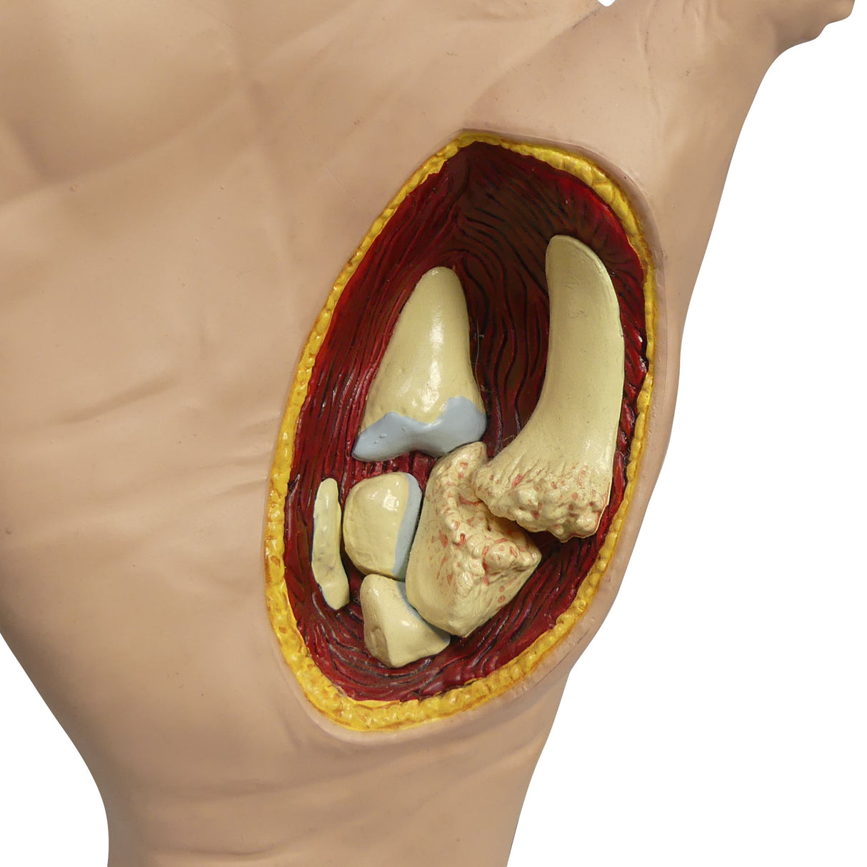 Right Hand Model with Osteoarthritis (OA)