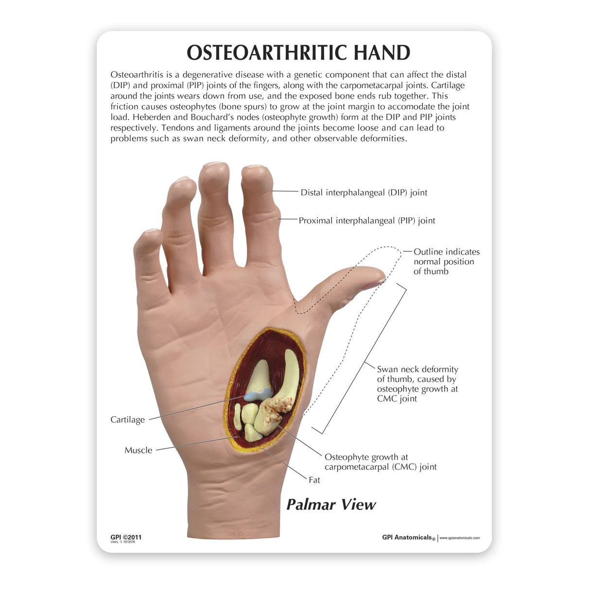 Right Hand with Osteoarthritis Education Card