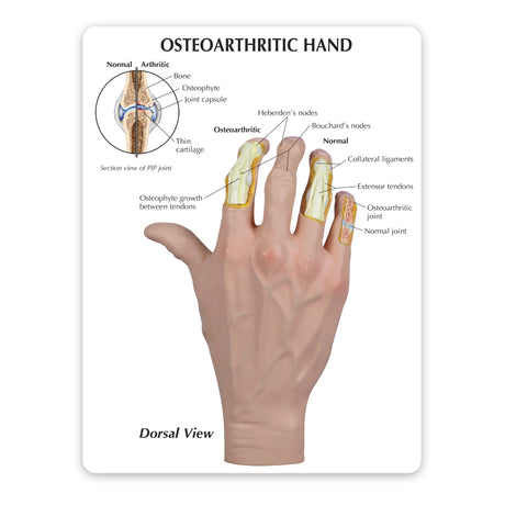 Right Hand Model with Osteoarthritis (OA)