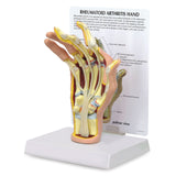 Right Hand Model with Rheumatoid Arthritis