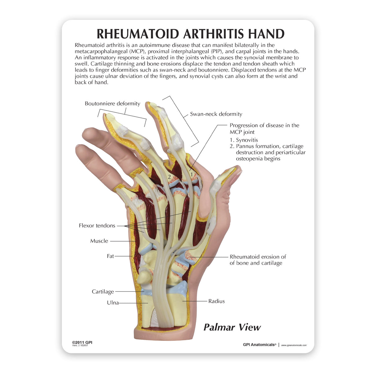 Right and with Rheumatoid Arthritis Education Card