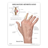 Right Hand Model with Rheumatoid Arthritis