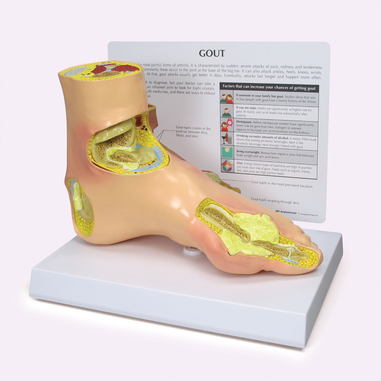 Left Foot Model with Gout