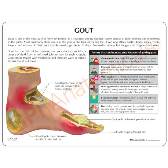 Left Foot with Gout Education Card