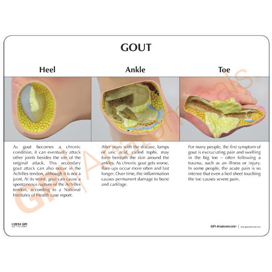 Left Foot with Gout Education Card