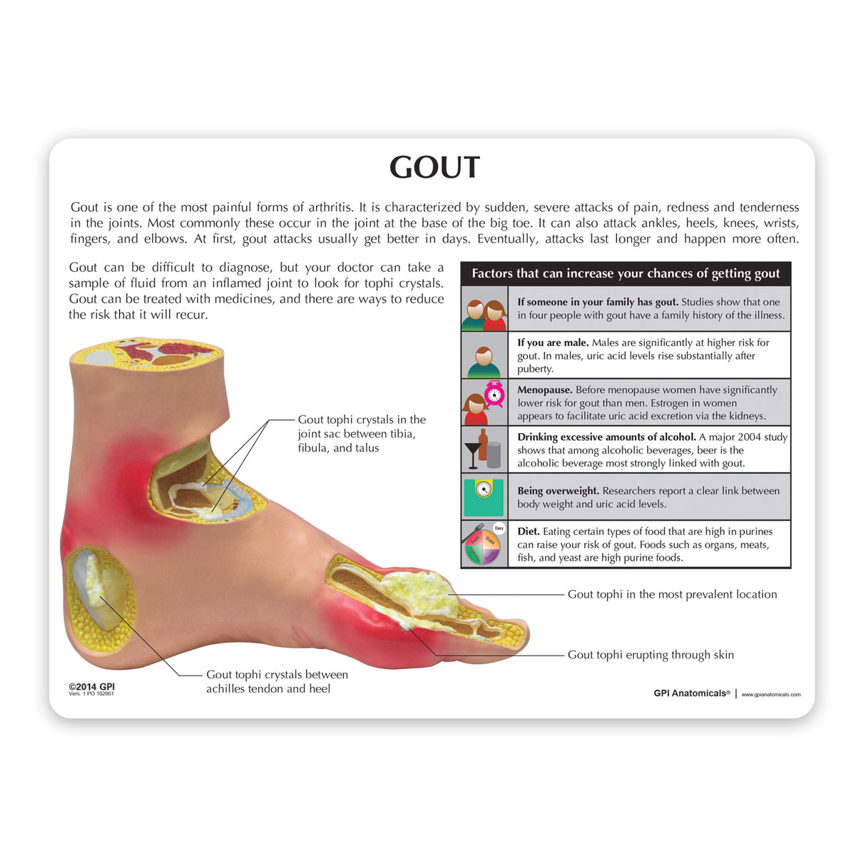 Left Foot Model with Gout