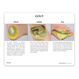 Left Foot with Gout Education Card