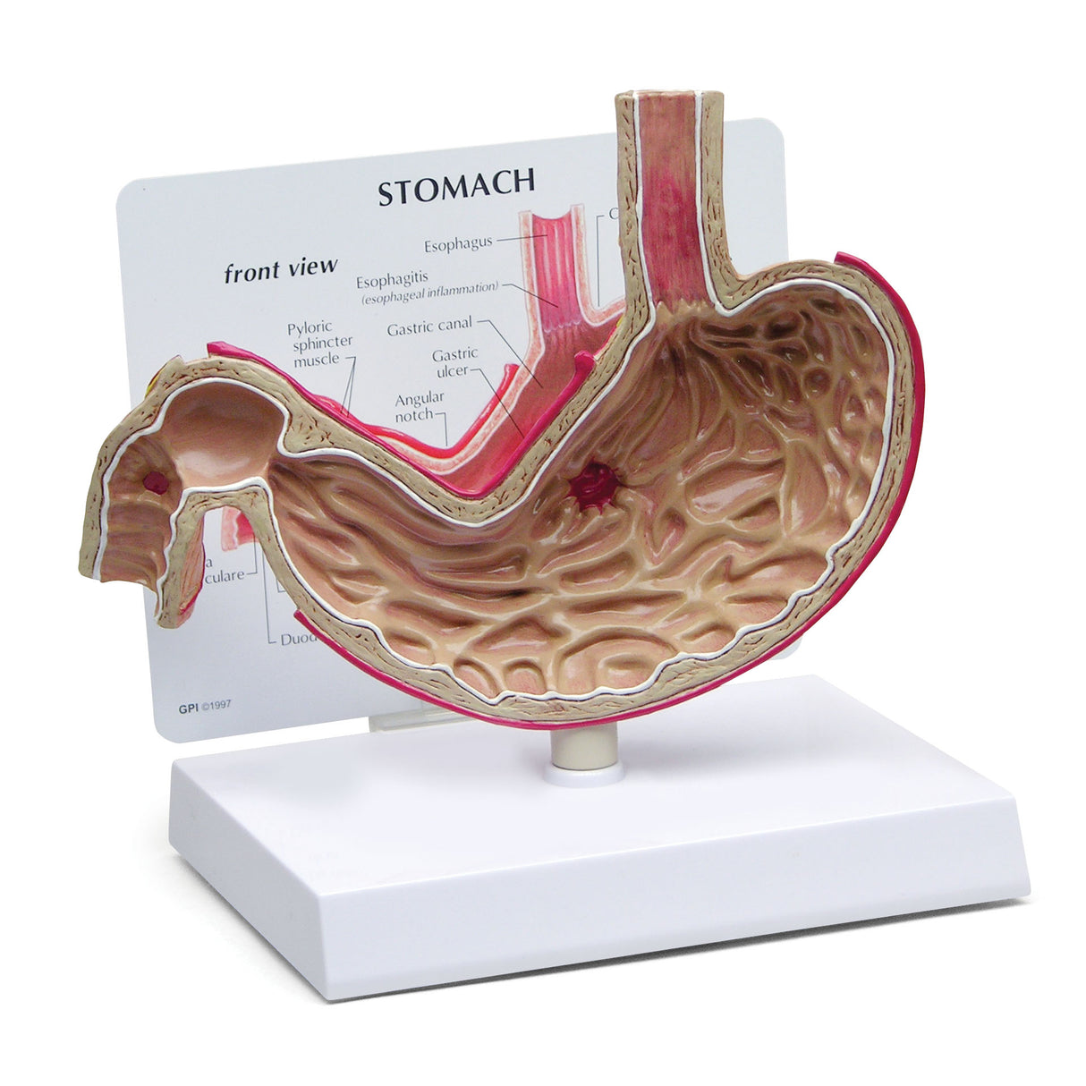 Stomach Model with Ulcers