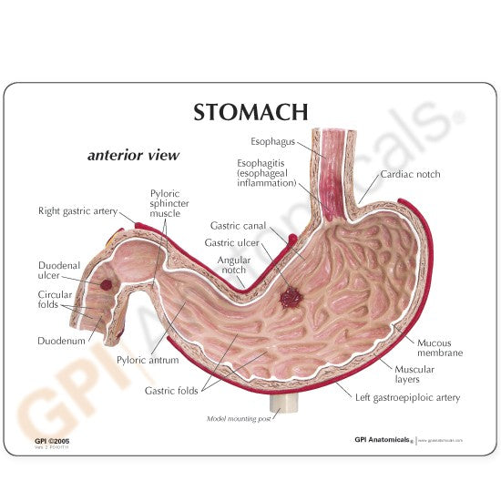 Stomach Model with Ulcers