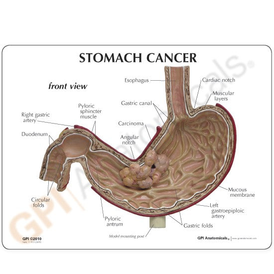 Stomach Cancer Education Card