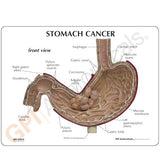 Stomach Cancer Education Card