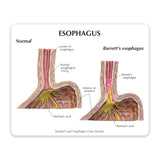 4-Piece Stomach Model Set with Gastroesophageal Reflux Disease (GERD)