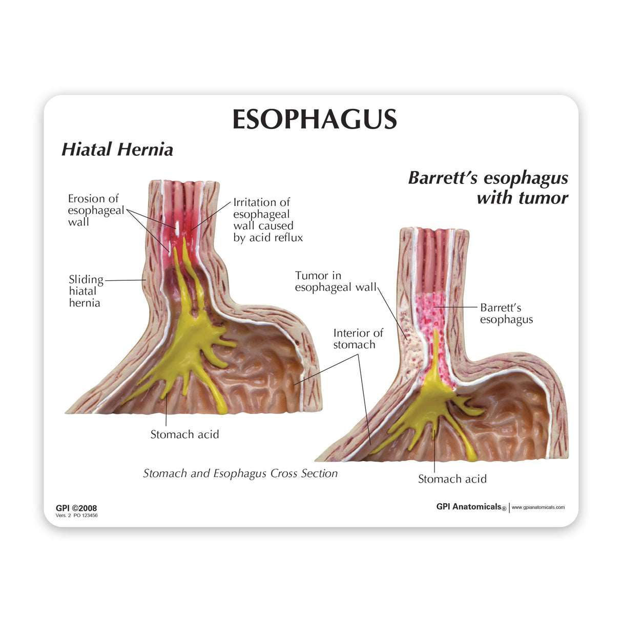 4-Piece Stomach Model Set with Gastroesophageal Reflux Disease (GERD)