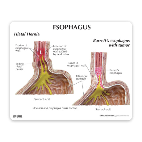 4-Piece Stomach Model Set with Gastroesophageal Reflux Disease (GERD)