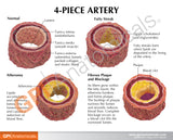 4-Piece Artery Model