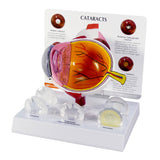 Cataract Eye Model