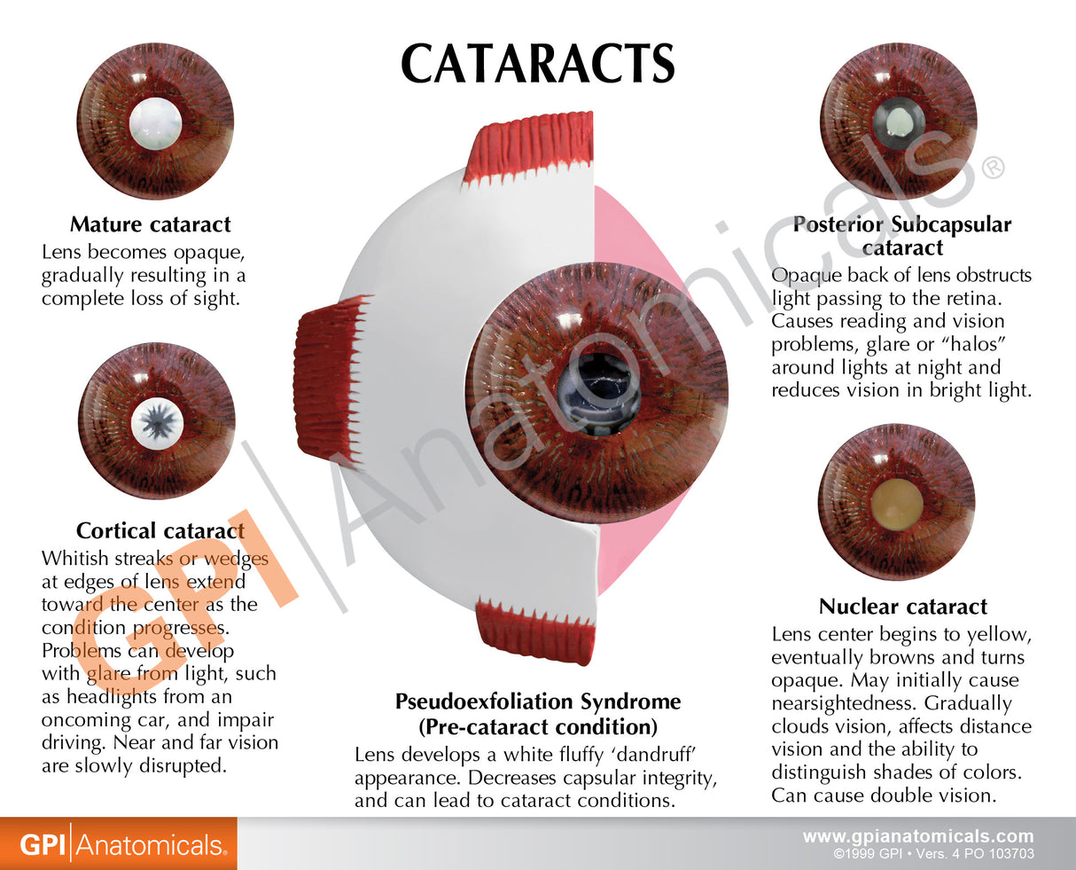 Cataract Eye Education Card