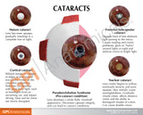 Cataract Eye Education Card