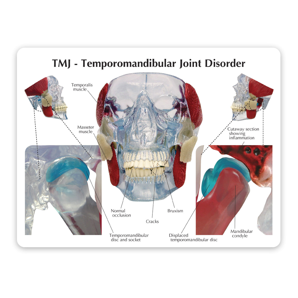 Temporomandibular Joint (TMJ) Model