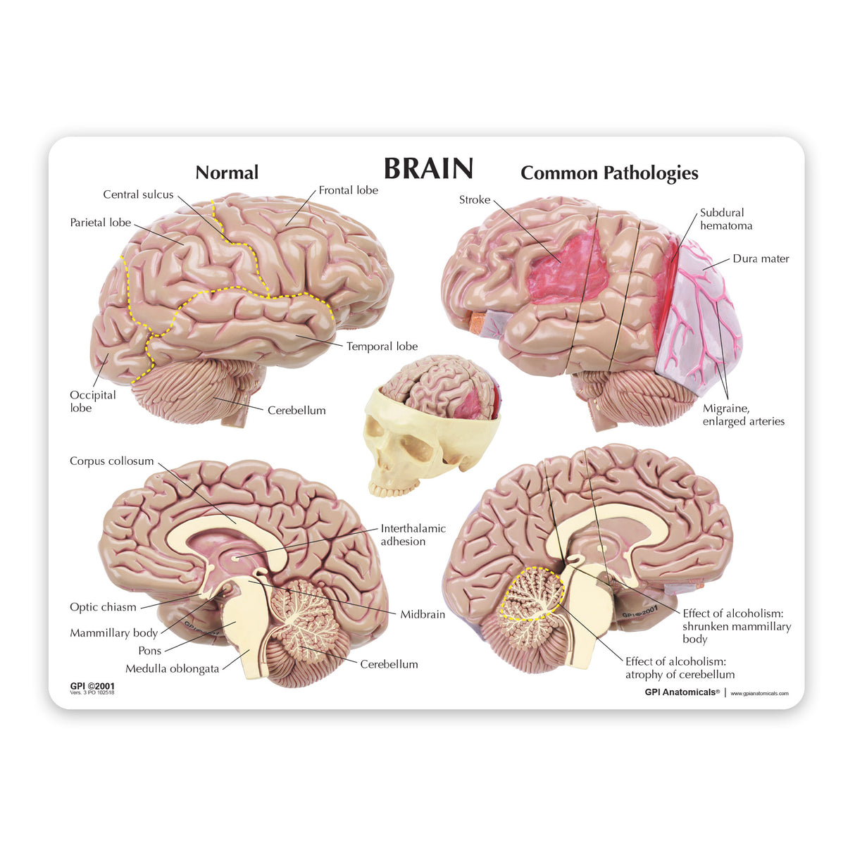 Brain with Partial Skull Model