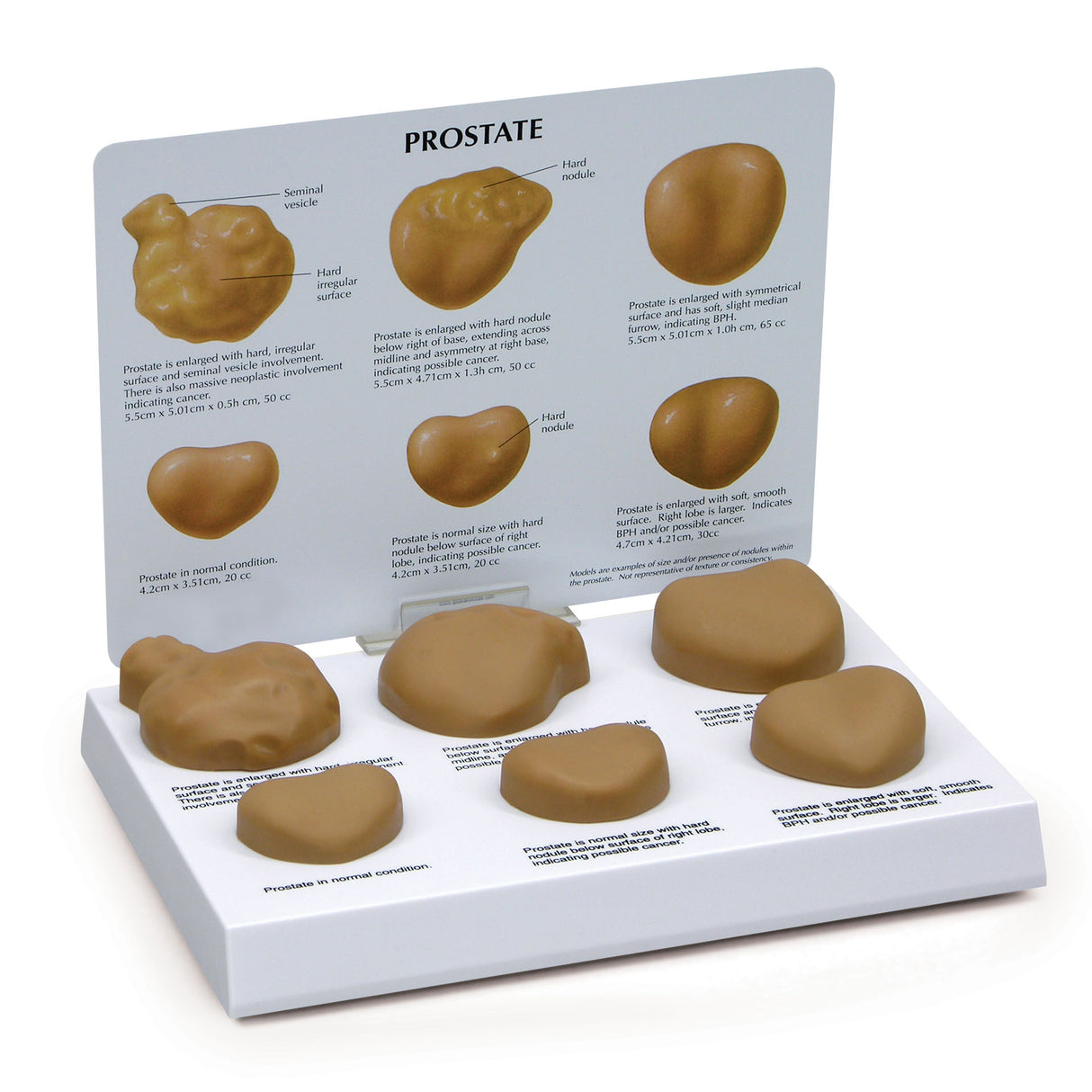 Prostate with Conditions Model Set